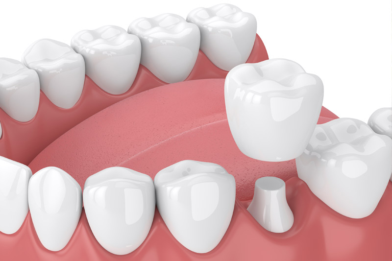 Dental Crowns in Berwyn