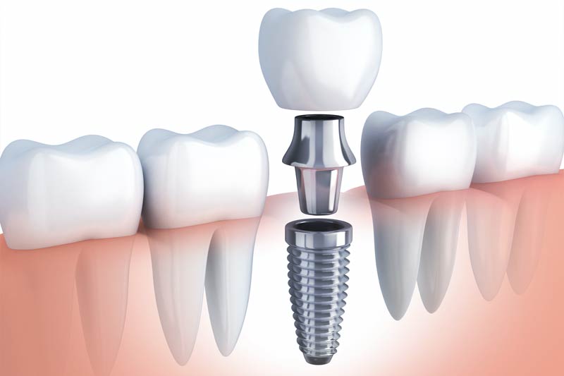 Implants Dentist in Berwyn